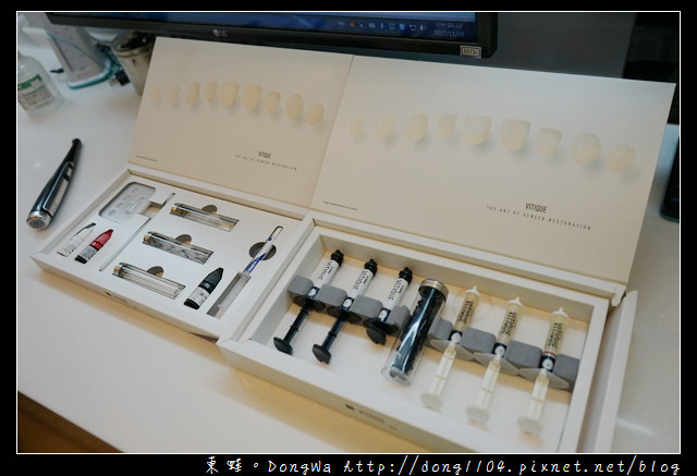 【新竹牙齒美白貼片推薦】陶瓷美白薄片 齒型雕塑 新竹日光翡麗牙醫診所 牙齒美白貼片實例發表會 【新竹牙齒美白貼片推薦】陶瓷美白薄片 齒型雕塑 新竹日光翡麗牙醫診所 牙齒美白貼片實例發表會