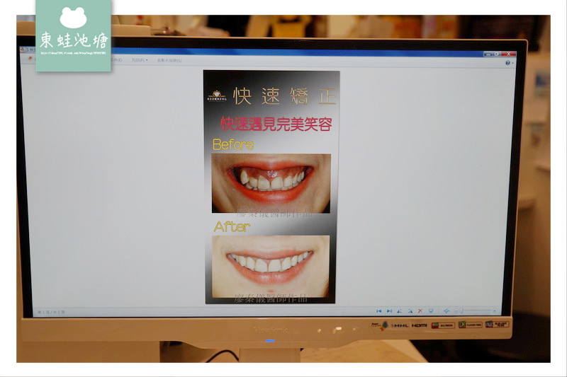 【新竹快速矯正推薦】竹北真美牙醫診所 美容矯正術前評估 晶鑽全瓷微笑設計 【新竹快速矯正推薦】竹北真美牙醫診所 美容矯正術前評估 晶鑽全瓷微笑設計